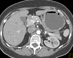 Gastric Cancer - CTisus CT Scan