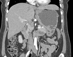 Gastric Cancer - CTisus CT Scan