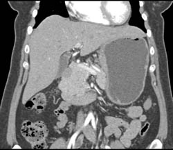 Gastric Cancer - CTisus CT Scan