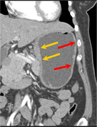 Gastric Cancer - CTisus CT Scan