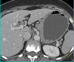 Gastric Cancer - CTisus CT Scan