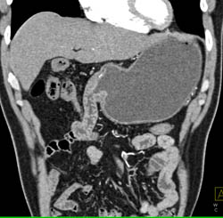 Gastrojejunostomy - CTisus CT Scan