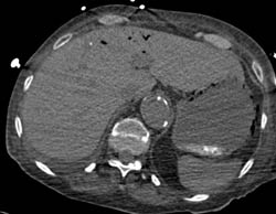 Portal Venous Air and Emphysematous Gastritis - CTisus CT Scan