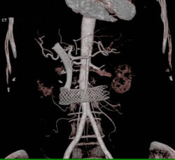 Stents in Duodenum and Antrum Due to Obstruction By Pancreatic Cancer - CTisus CT Scan