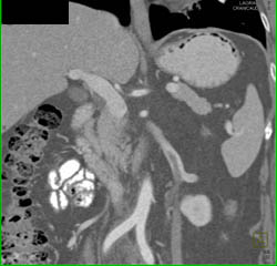 Benign Gastric Emphysema and Left Gonadal Vein Thrombosis - CTisus CT Scan