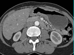 Gastric Adenocarcinoma Infiltrating the Antrum - CTisus CT Scan