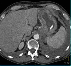 Gastric Adenocarcinoma With Celiac Nodes and Carcinomatosis - CTisus CT Scan