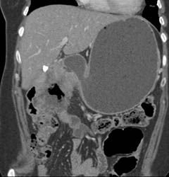 Antral Carcinoma With Bulky Nodes - CTisus CT Scan