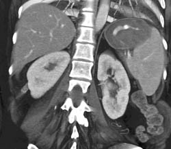 Active Bleed in the Stomach S/P Cyst Gastrostomy - CTisus CT Scan