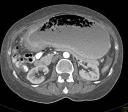 Antral Carcinoma With Carcinomatosis and Gastric Outlet Obstruction - CTisus CT Scan