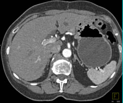 Recurrence at Gastrojejunostomy Site - CTisus CT Scan