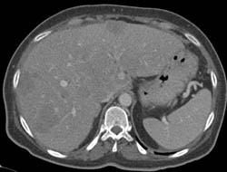 GIST Tumor With Liver Metastases and Tumor Implants - CTisus CT Scan