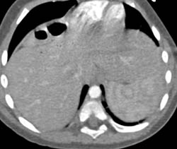 Chilaiditi Syndrome - CTisus CT Scan