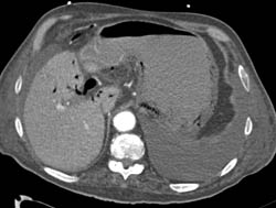 Ischemic Gastritis With Air in Portal Vein and Colon- Gastric Emphysema - CTisus CT Scan