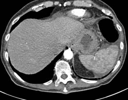 Recurrent Gastric Cancer With Nodes S/P Patient Gastrectomy - CTisus CT Scan