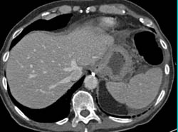 Gastric Adenocarcinoma - CTisus CT Scan