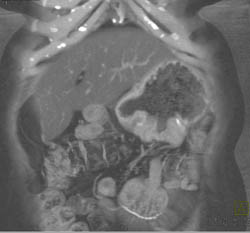 Gastric Adenocarcinoma - CTisus CT Scan