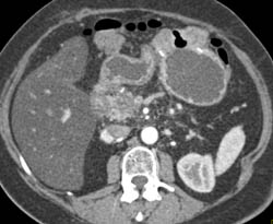 Gastric Adenocarcinoma - CTisus CT Scan