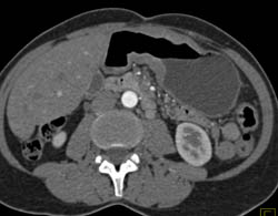 Antral Carcinoma - CTisus CT Scan