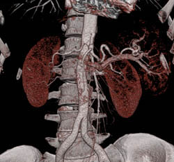 Antral Carcinoma - CTisus CT Scan