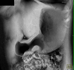 Antral Carcinoma - CTisus CT Scan