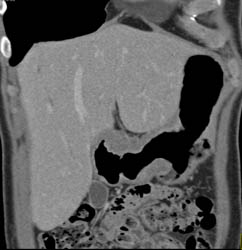 Antral Carcinoma - CTisus CT Scan