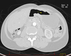 Antral Carcinoma - CTisus CT Scan