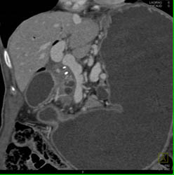 Antral Cancer With Gastric Outlet Obstruction - CTisus CT Scan