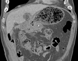 Antral Carcinoma With Tumor Spread in Perigastric Zone - CTisus CT Scan