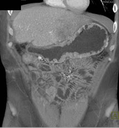 Gastric Cancer With Enhancing Folds - CTisus CT Scan