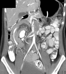 Cyst Gastrostomy - CTisus CT Scan