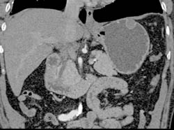 1cm GIST Tumor - CTisus CT Scan