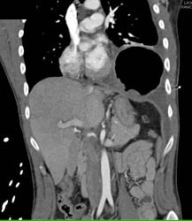 Tear in Diaphragm With Stomach Extending Through Defect and Was Now Ischemic - CTisus CT Scan