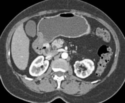 Antral Carcinoma Vs Carcinoid- See Enhancing Lesion - CTisus CT Scan