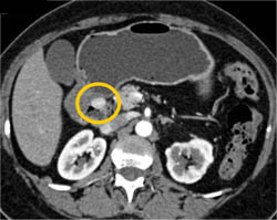 Carcinoid of the Stomach - CTisus CT Scan