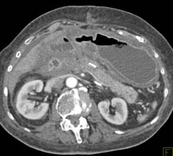 Antral Carcinoma With Tumor Spread - CTisus CT Scan