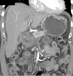 Gastric Cancer - CTisus CT Scan