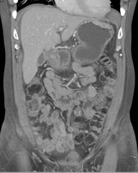 Gastric Cancer - CTisus CT Scan