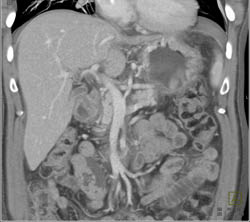 Gastric Cancer - CTisus CT Scan