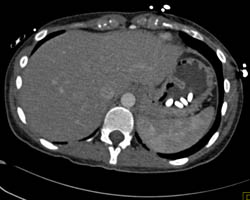 Pills in Stomach - CTisus CT Scan