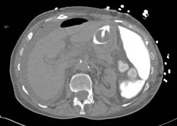 Gastric Perforation - CTisus CT Scan