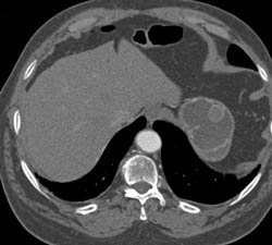 GIST Tumor Fundus - CTisus CT Scan