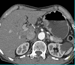 Antral Carcinoma With Liver Metastases - CTisus CT Scan