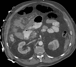 Antral Carcinoma - CTisus CT Scan