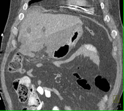 Perforated Ulcer - CTisus CT Scan