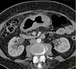 Antral Carcinoma - CTisus CT Scan