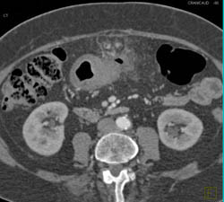 Antral Carcinoma - CTisus CT Scan