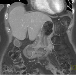 Antral Carcinoma - CTisus CT Scan