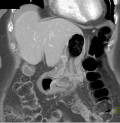 Antral Carcinoma - CTisus CT Scan