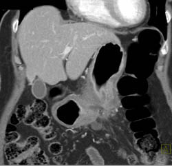 Antral Carcinoma - CTisus CT Scan